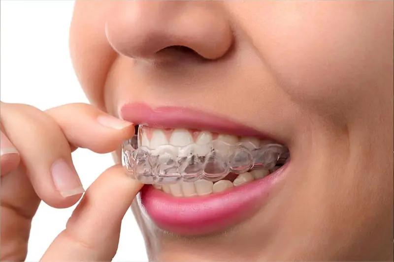 Διαφανείς νάρθηκες Invisalign — αόρατη ορθοδοντική θεραπεία