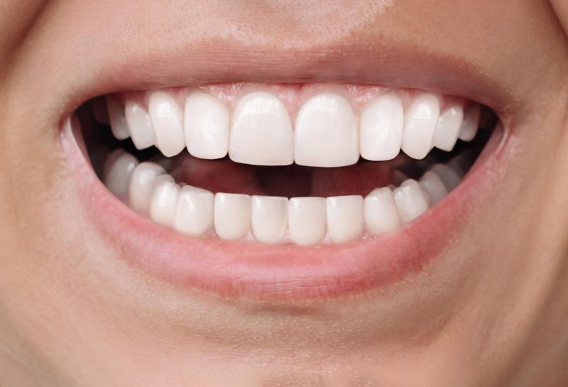 Ορθοδοντική θεραπεία μετά - orthodontikos athina TK Orthodontics