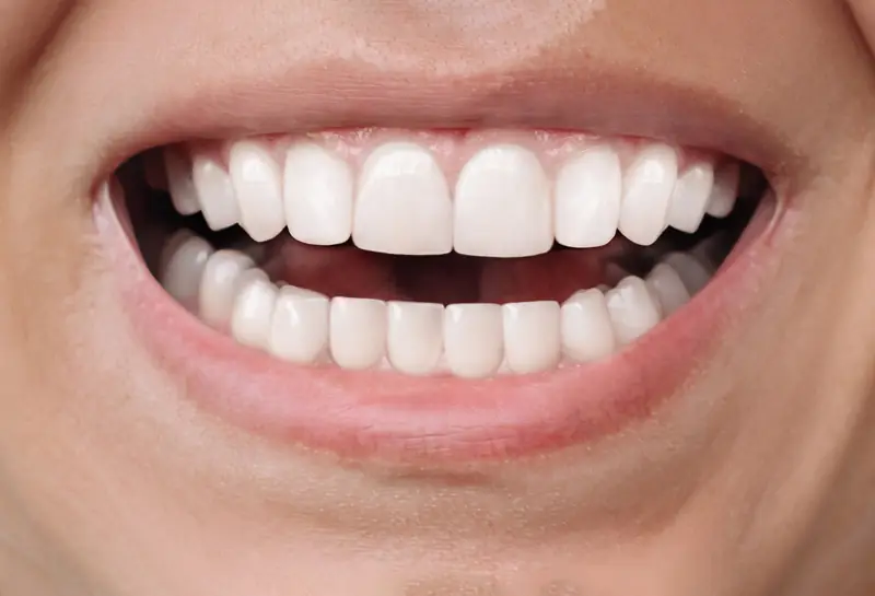 Μετά: ευθυγραμμισμένα δόντια μετά από Invisalign