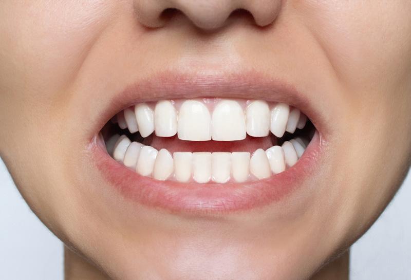 Invisalign μετά - orthodontikos athina iatreio TK Orthodontics