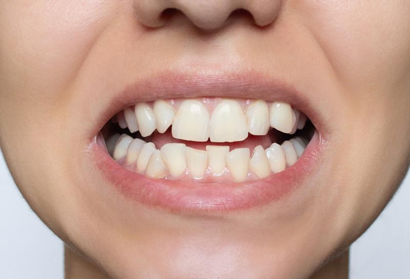 Invisalign πριν - orthodontikos athina iatreio TK Orthodontics