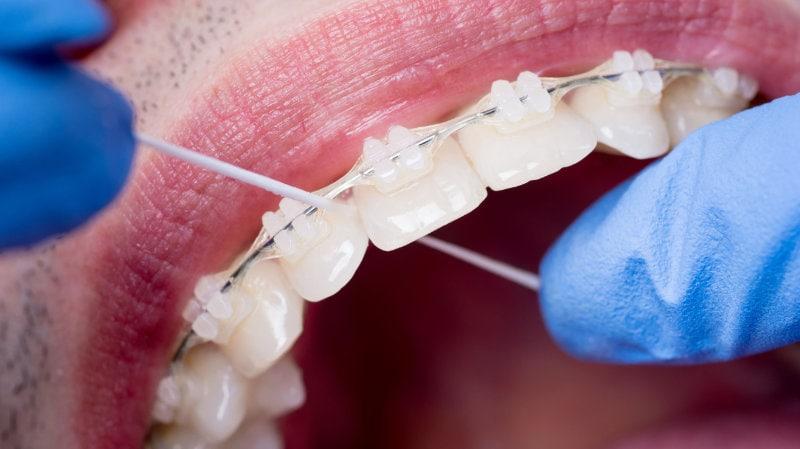 Κεραμικά σιδεράκια - orthodontikos athina iatreio tkorthodontics